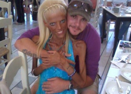 anorexia struggle battle